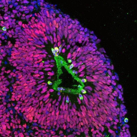 Title of Image: The blooming human cerebral cortex in a dish

Description of Image: Section of a human cortical spheroid derived from stem cells shows progenitors (pink) and dividing cells (green) around a ventricle-like structure. This 3D culture resembles the fetal cerebral cortex.

Area of focus: NeuroDiscovery

Submitted by: Anca Pasca, Postdoctoral Research Fellow, Neonatal and Developmental Medicine

Lab: Sergiu Pasca, Assistant Professor of Psychiatry and Behavioral Sciences - Stanford Center for Sleep Sciences and Medicine